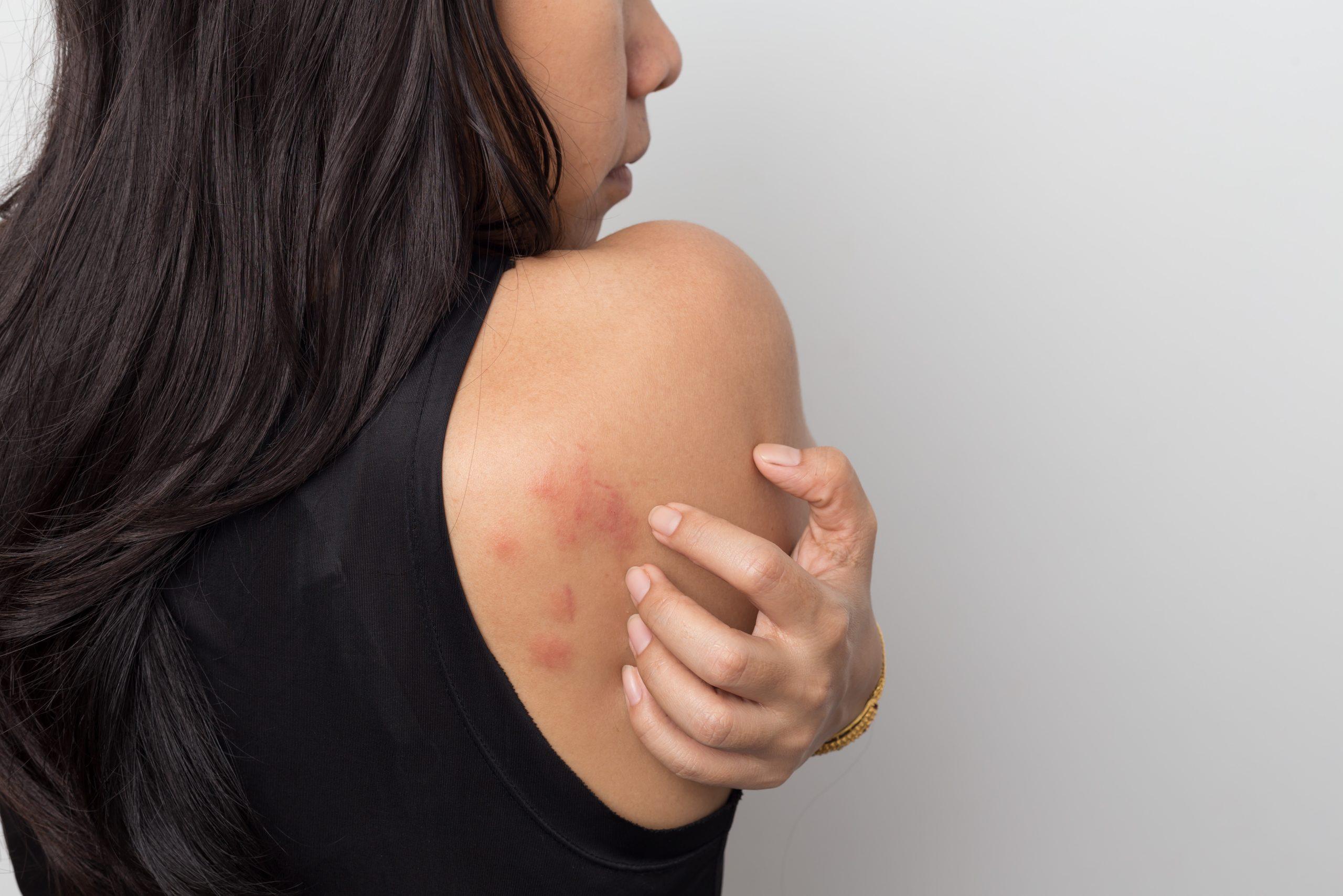 What is Contact Dermatitis?